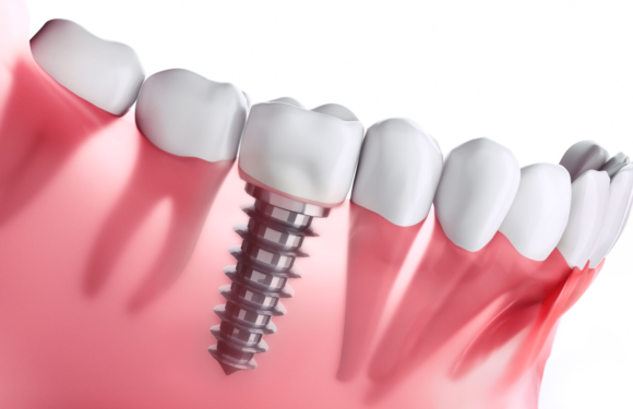 Какие зубные импланты лучше: критерии оценки и самые популярные бренды