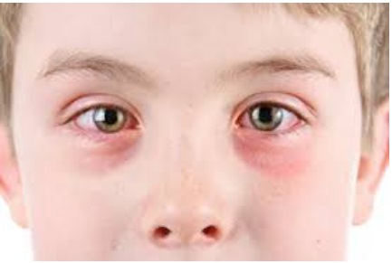 Алергічний кон’юнктивіт: комплексний підхід до діагностики та лікування